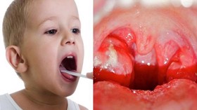 Trẻ bị viêm amidan - Thông tin cần biết giúp điều trị hiệu quả